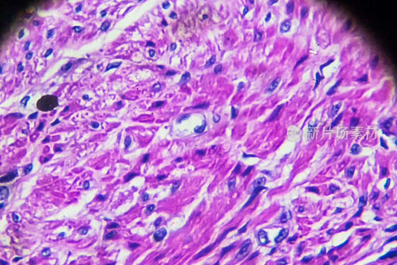 显微镜下子宫内膜癌生物样本