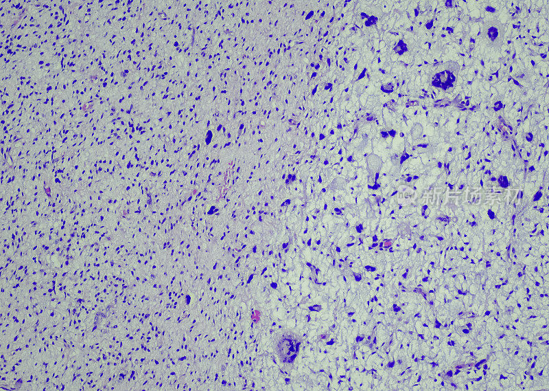 Myxofibrosarcoma