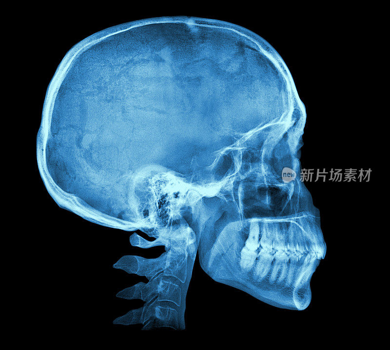 人类颅骨x射线图像