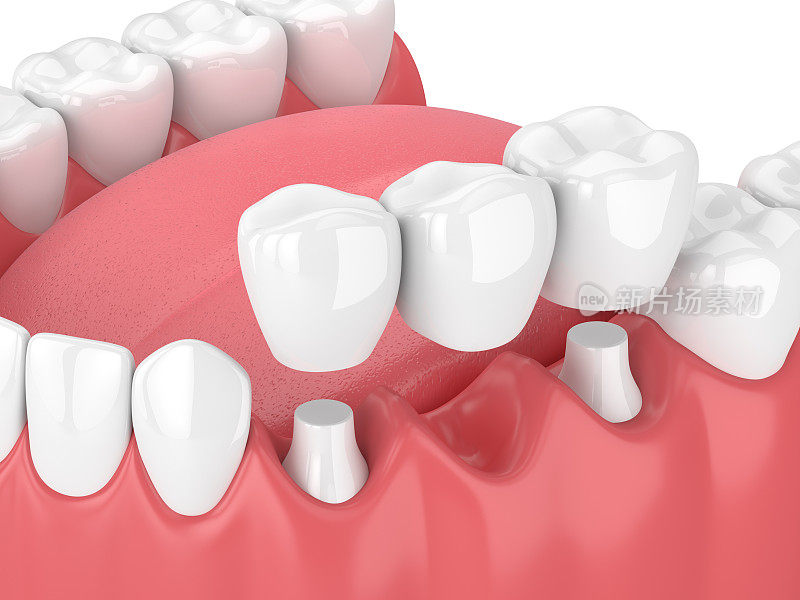 颌骨的3d渲染与牙科桥