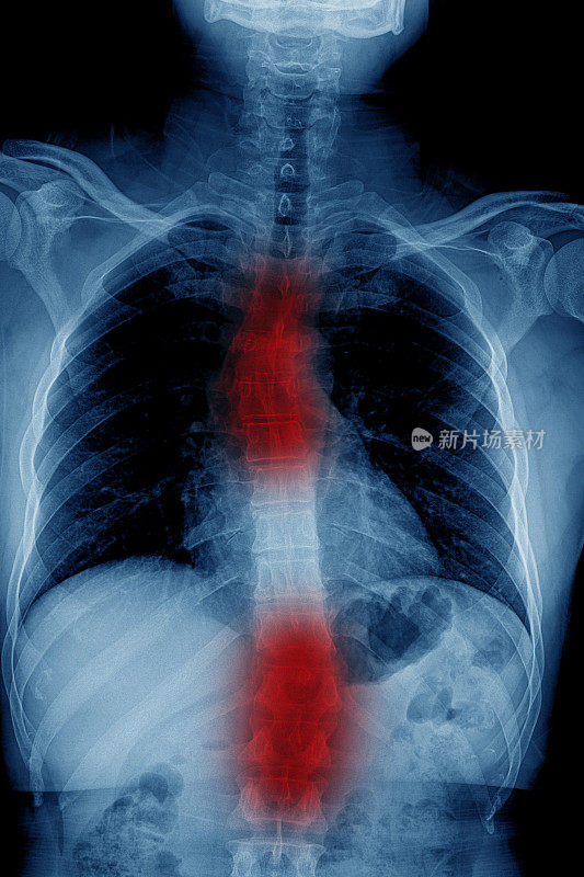 暗背景胸腰椎x线片。