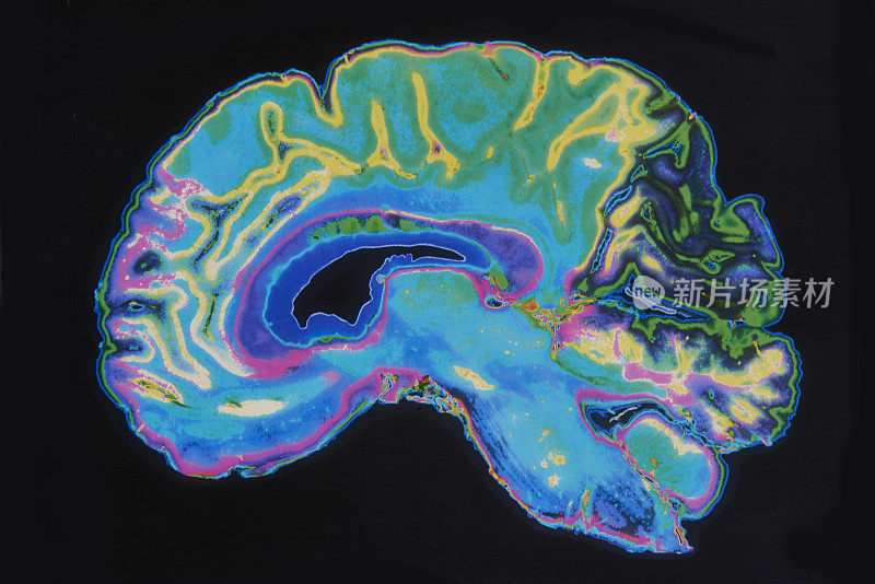 MRI图像在黑色背景上的大脑
