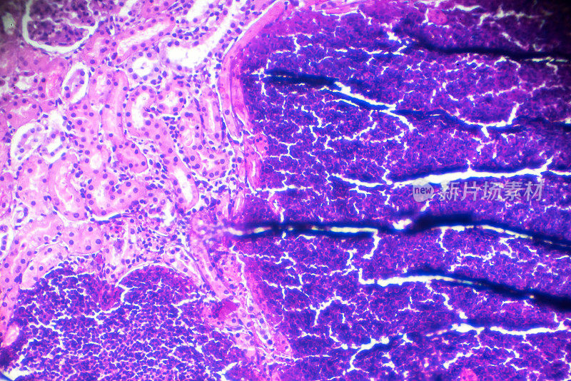 显微镜下急性肾盂肾炎活检标本