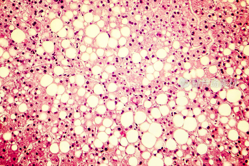 脂肪肝的光学显微镜照片