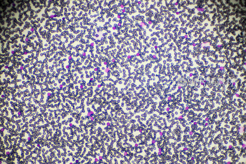光镜下急性淋巴母细胞白血病ALL-L3血液涂片