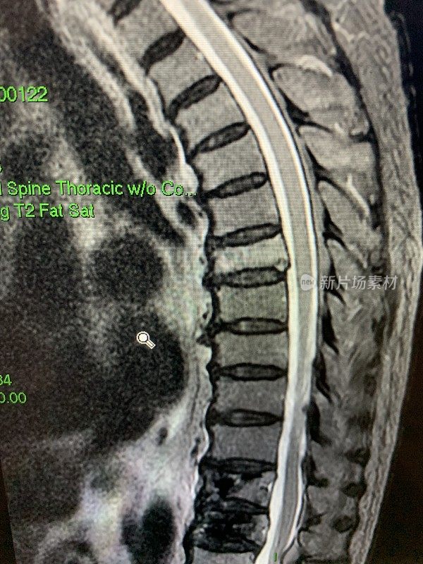 胸椎T6转移的MRI搅动图像