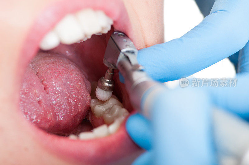闭合的女性病人的嘴与完美的牙齿