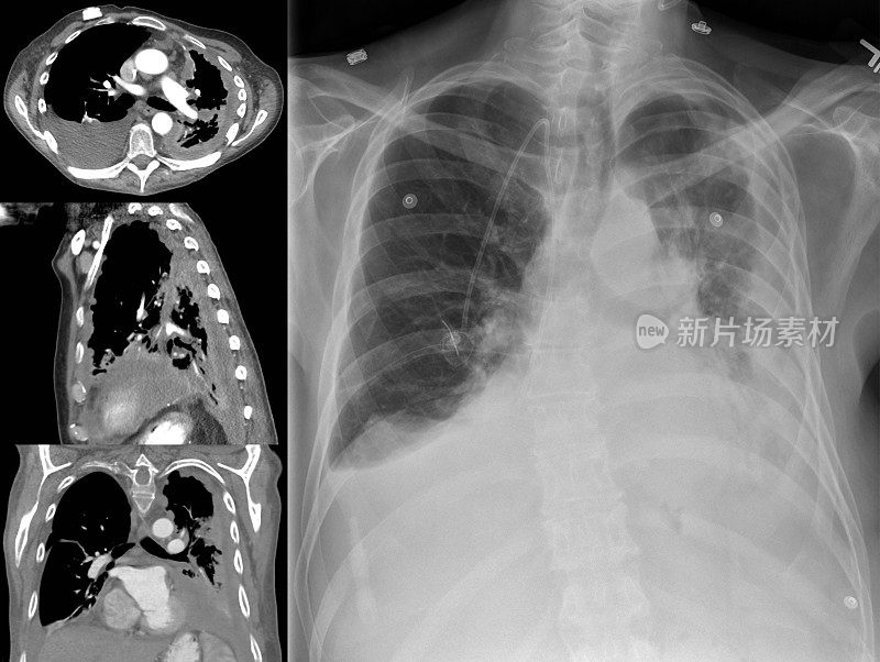 CT和x线检查显示石棉暴露导致的晚期间皮瘤