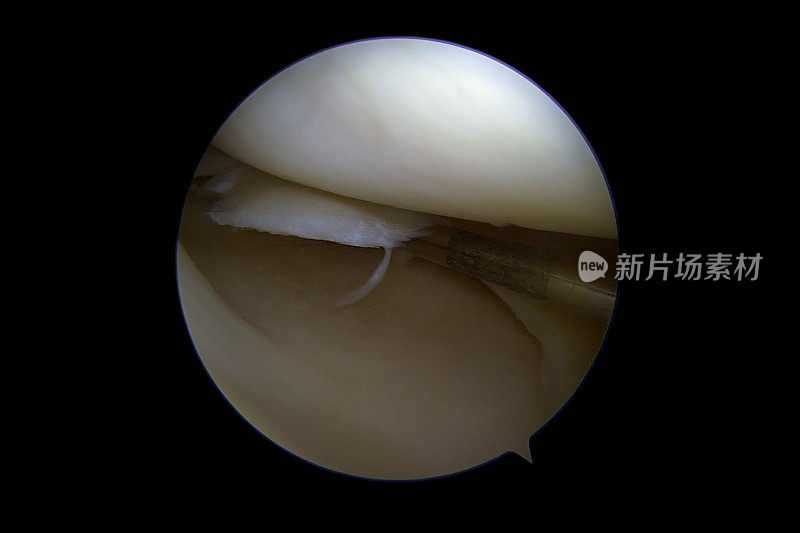 右膝关节内侧室半月板撕裂的关节镜照片