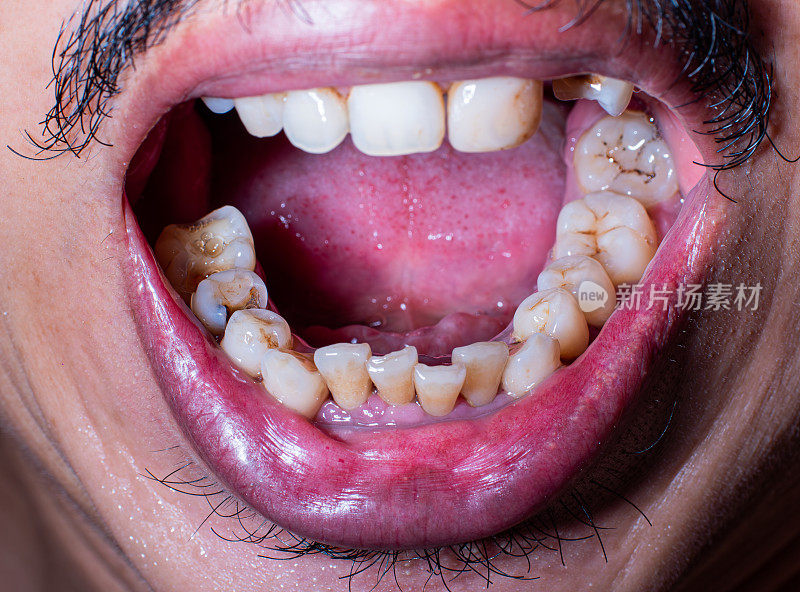 口腔和牙齿健康状况不佳、蛀牙、牙龈疾病和牙龈肿胀都会导致牙痛。牙齿被染黑了，又脏又黄。