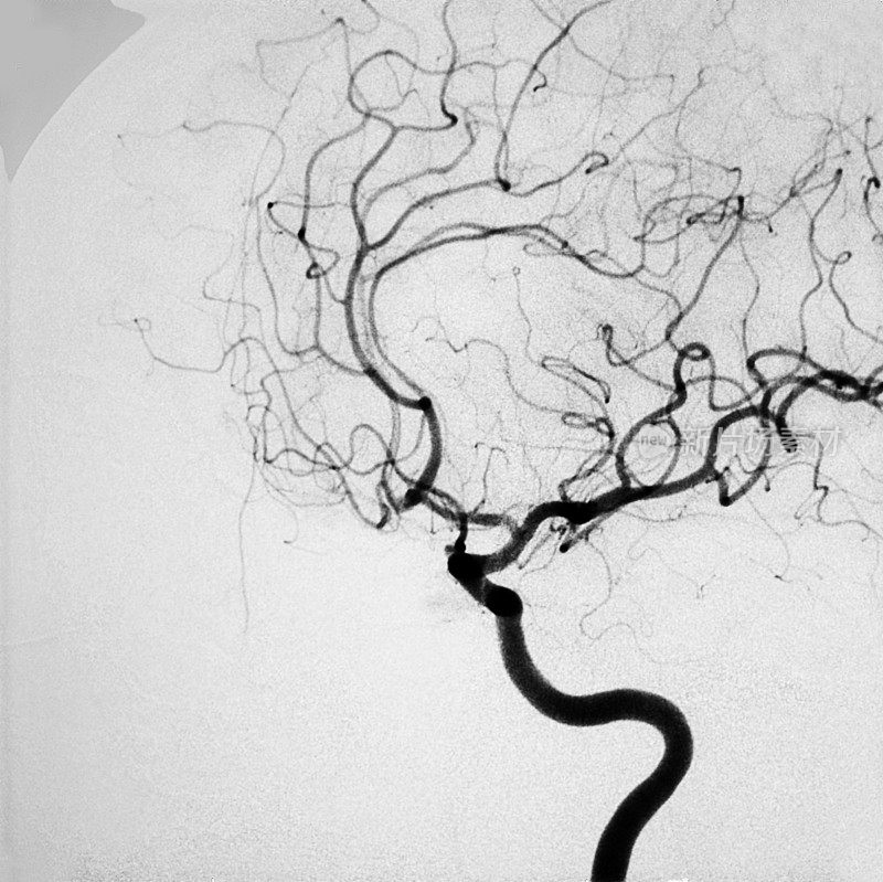 颈内动脉DSA图像