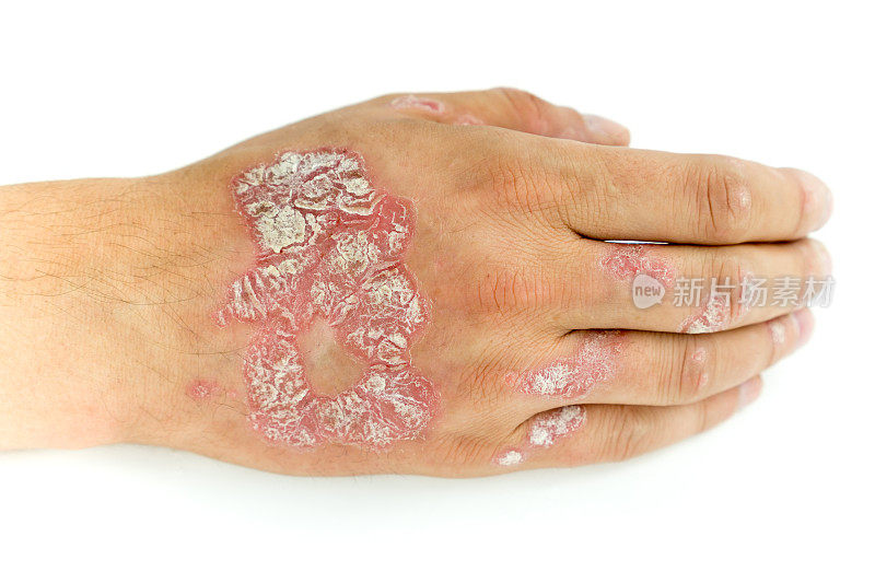 寻常型银屑病和真菌患者手部和手指上有斑块、皮疹和斑块，孤立在白色背景上。自体免疫的基因疾病。