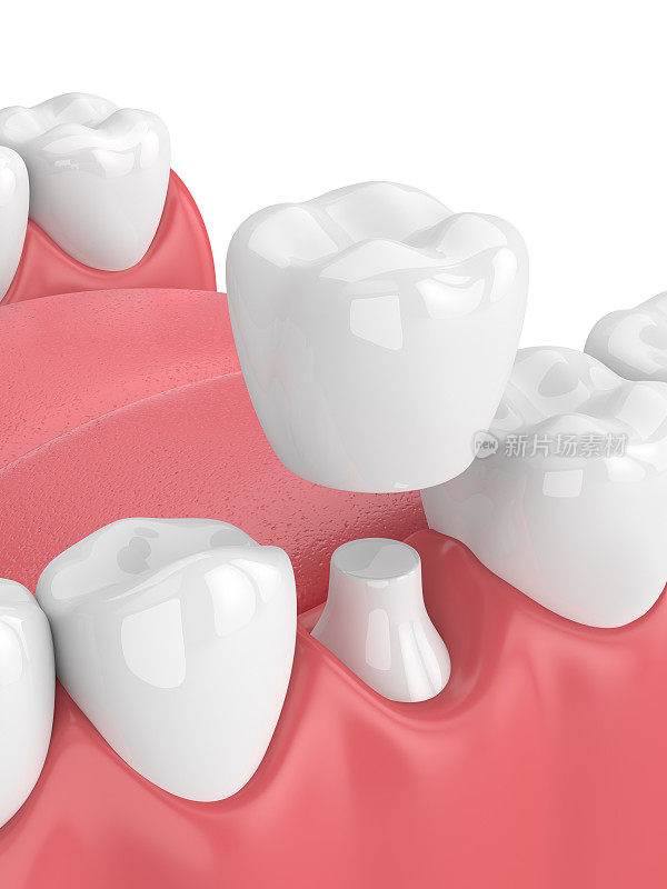 3d渲染颌骨与牙齿和牙冠修复