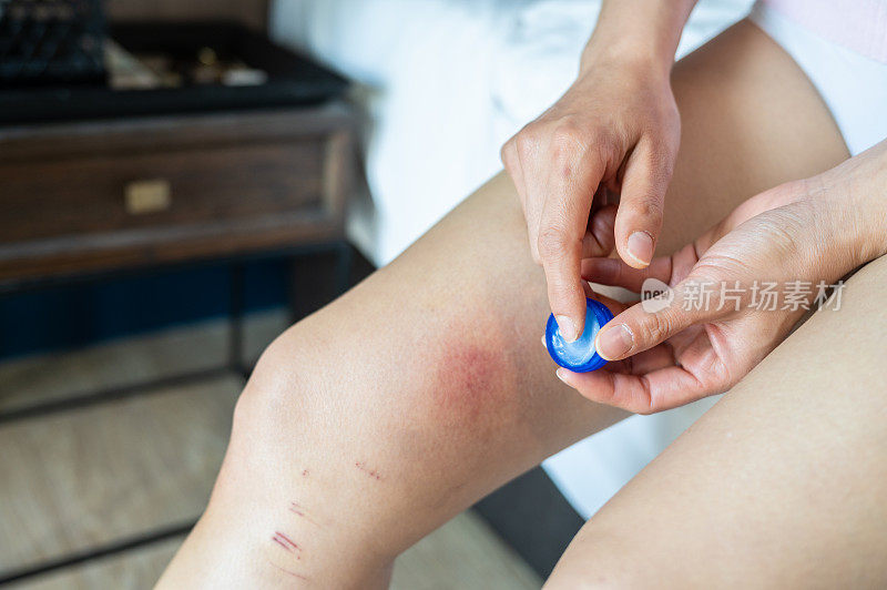 一名妇女在涂药膏治疗大腿上的红疹(或淤青)。