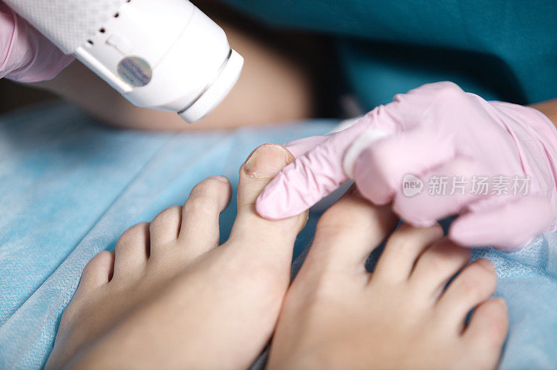 一名女子正在接受脚部激光治疗