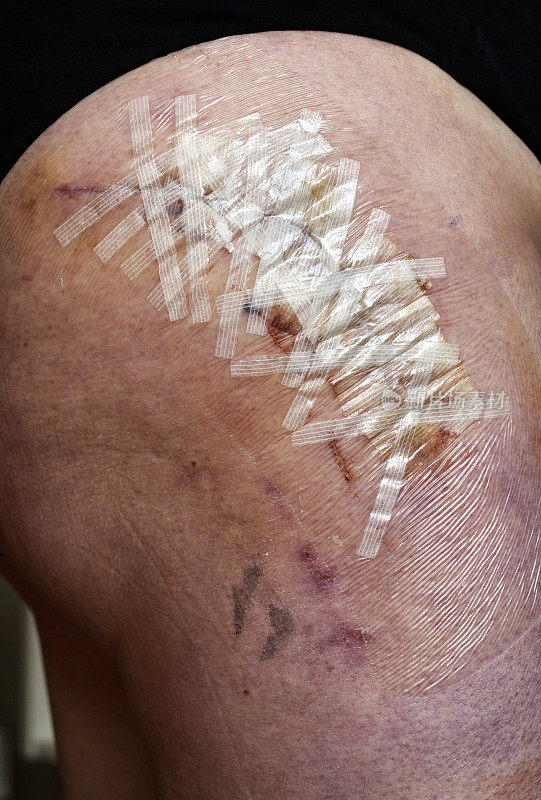 老年妇女髋关节置换术伤口有无菌条和淤青