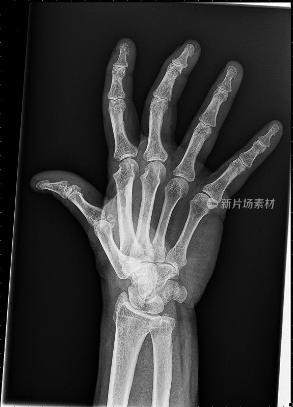 x射线的手