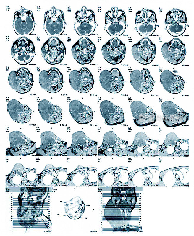 颈部MRI(磁共振成像)，横断面