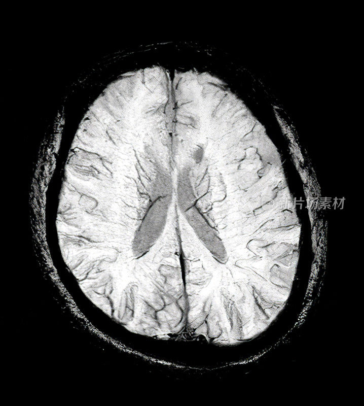 磁共振成像脑部扫描图像(MRI)