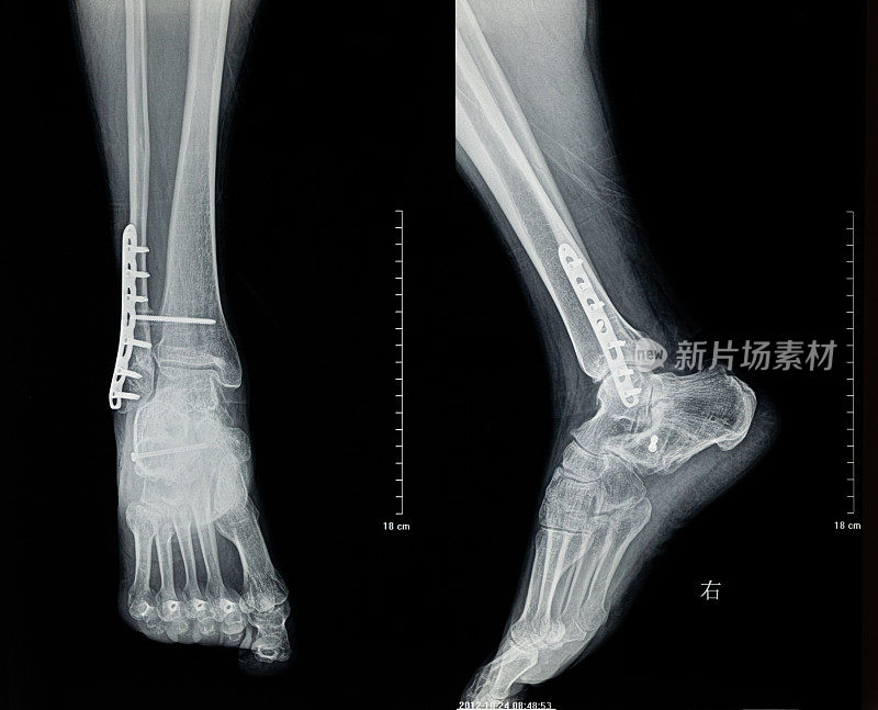 人体腿部和足部x光片