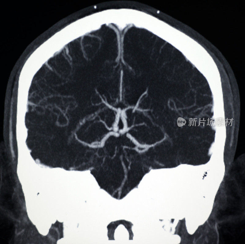 脑部CT图像显示大脑动脉