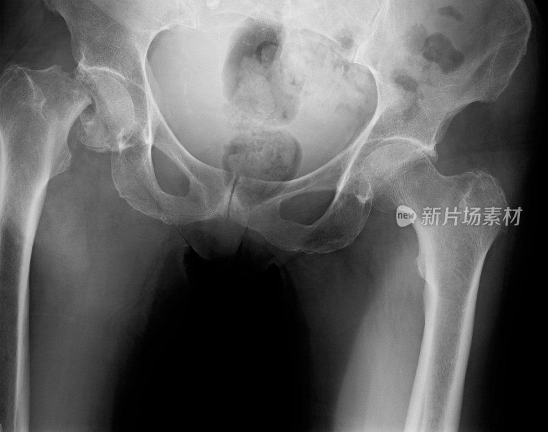 骨盆x光片显示右髋部骨折