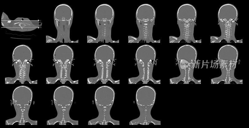 头部CAT扫描图像