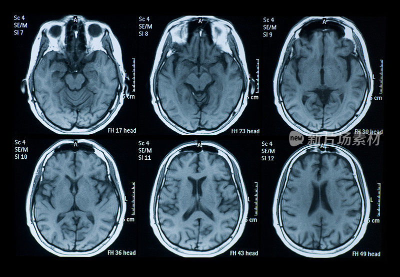 几张核磁共振成像显示了大脑扫描