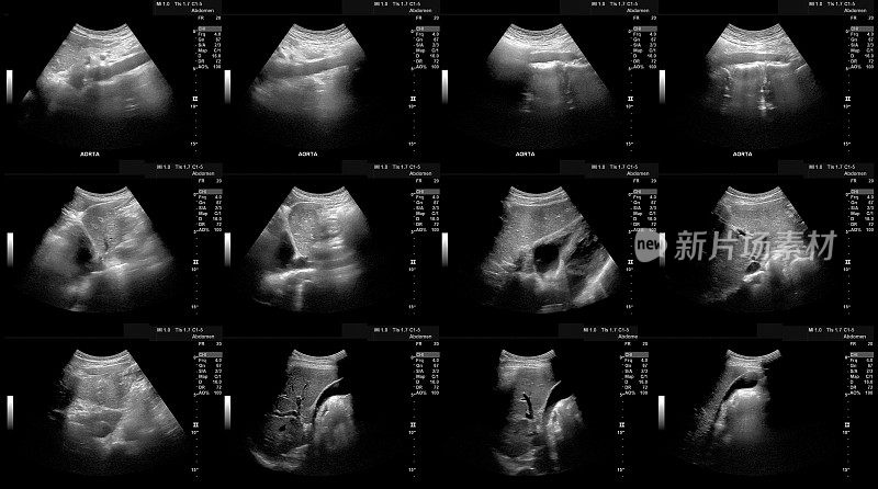 人体腹部的超声波和主动脉