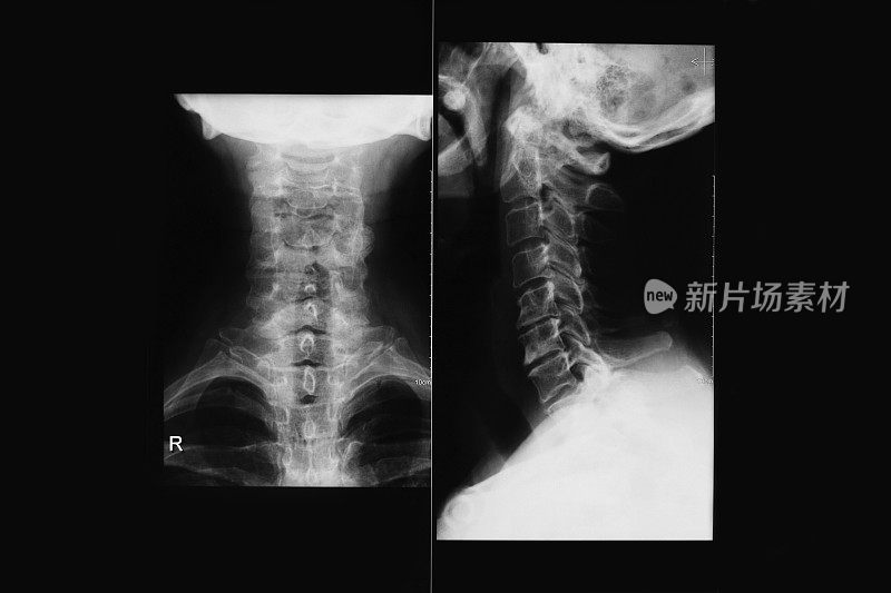 颈部有两个凸点的x光照片