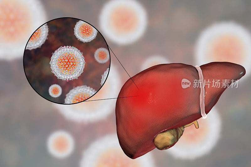 丙型肝炎感染的肝脏和丙型肝炎病毒近照
