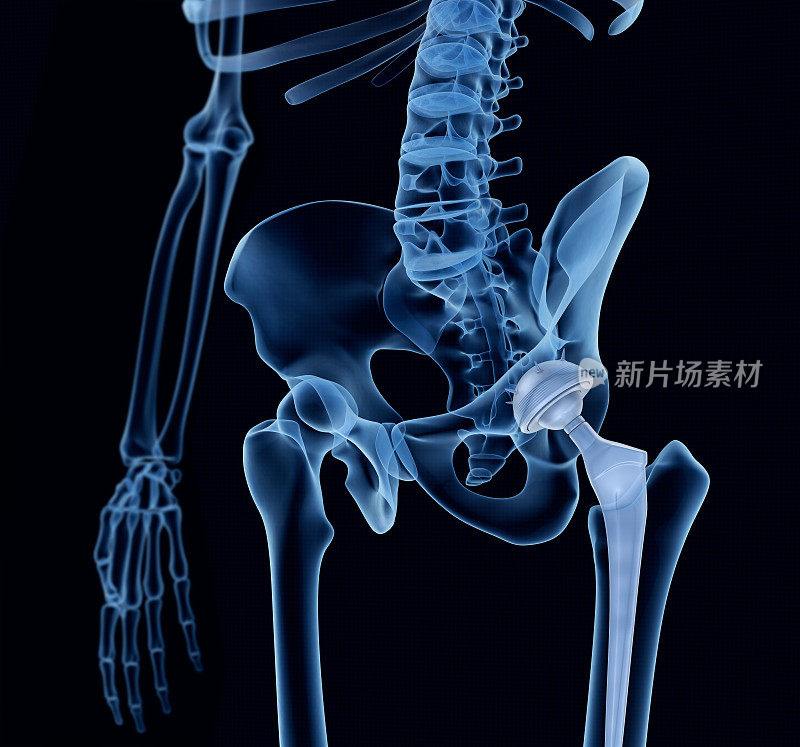 髋关节置换植入物安装在骨盆骨。x射线的观点。