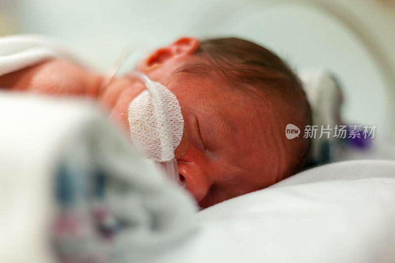 新生儿重症监护室早产儿的头儿