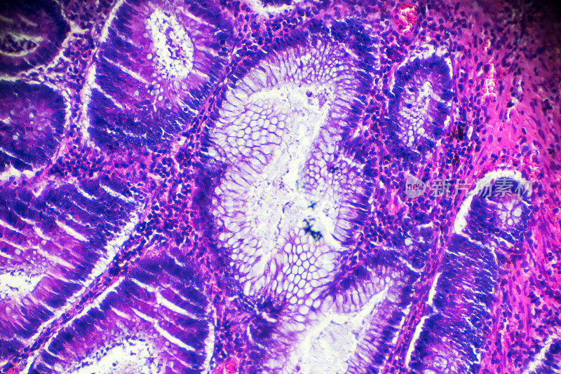 显微镜下的大肠癌(差异很大，管状腺癌)