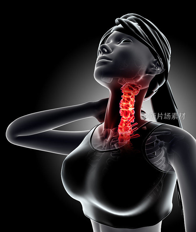颈部疼痛-颈椎骨骼x光，3D插图。