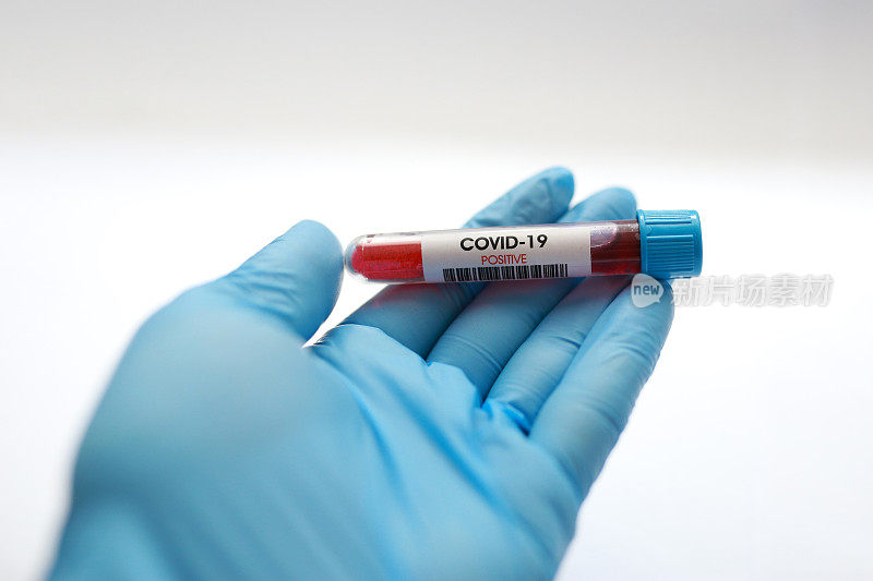 冠状病毒的血液测试。实验室的冠状病毒阳性血液测试结果在后台