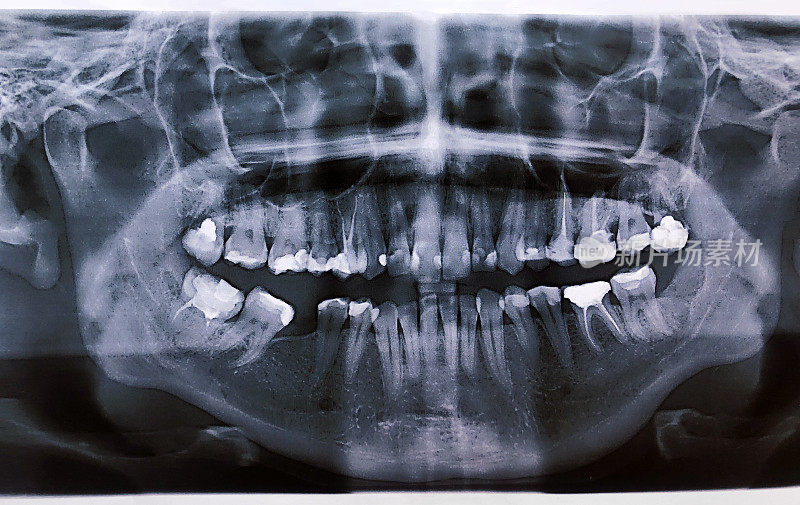 近全景x光的牙齿和颌骨的人