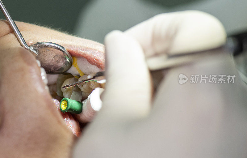 年轻女性进行牙科检查和牙科手术