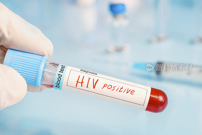 诊断学家手里拿着蓝色实验室背景的HIV阳性检测结果。