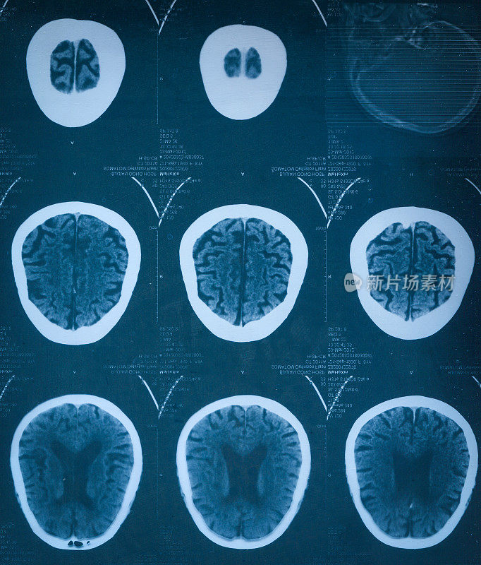 MRI扫描人类头部胶片