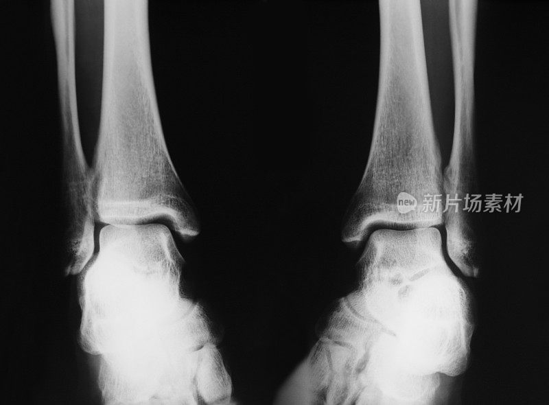 人体脚踝的x光图像