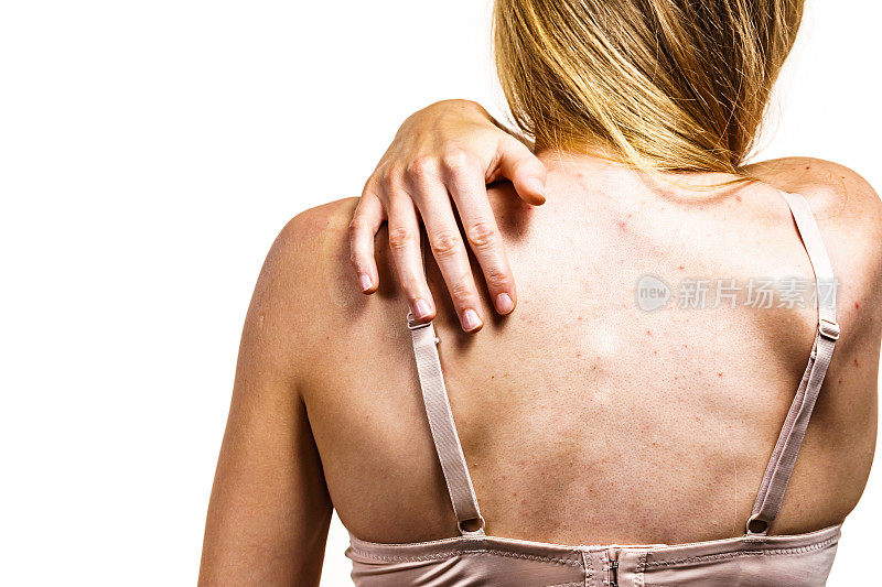 女人有皮肤问题，背部有粉刺