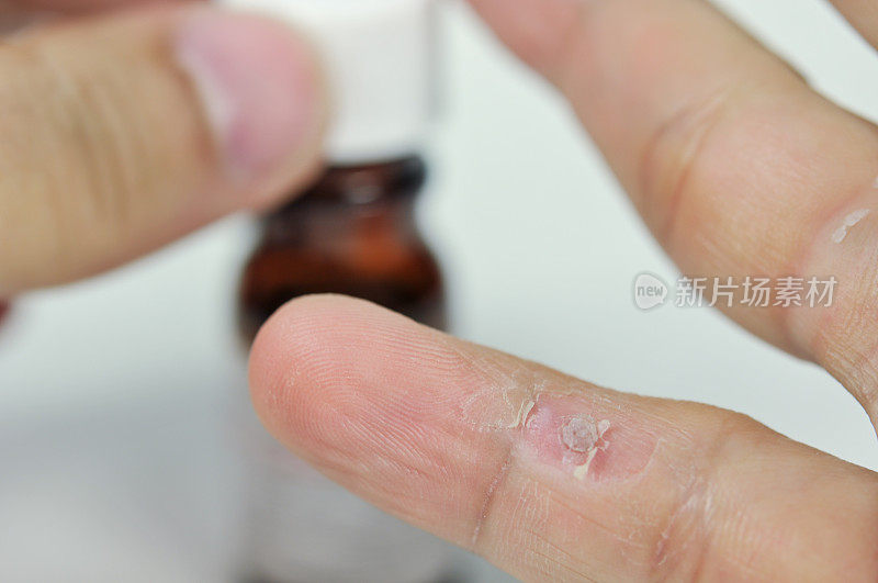 水杨酸治疗手指疣。