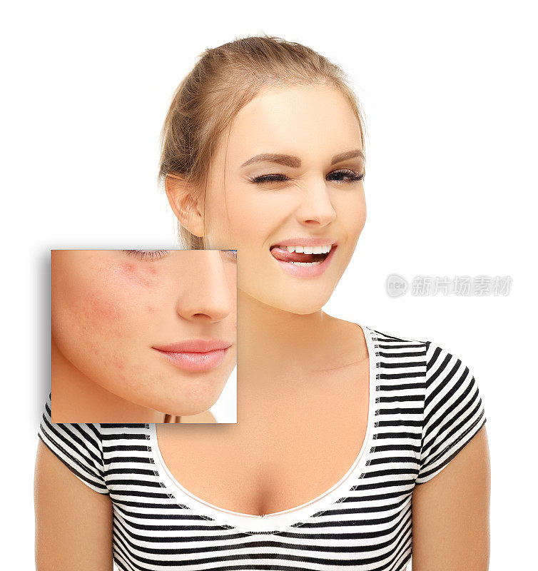 Post-Acne标志,痤疮疤痕