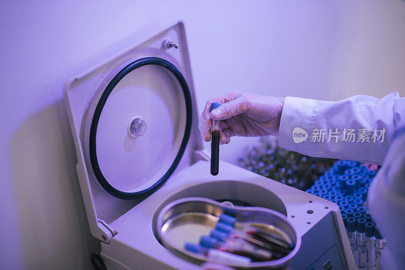 亚洲华人护士做prp治疗和血小板丰富的血浆治疗使用离心机保存血液采集管