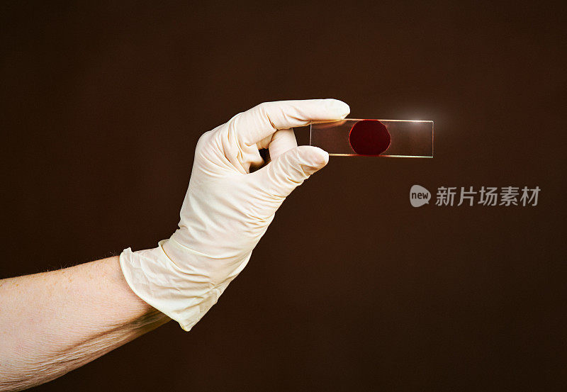 戴着外科手套的手拿出一个玻璃显微镜载玻片，其中含有血液样本