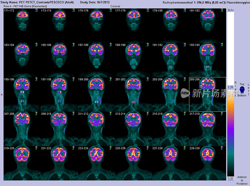 PET-CT冠状扫描大脑
