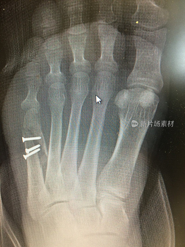 固定失败的足部骨折x线照片，AP视图