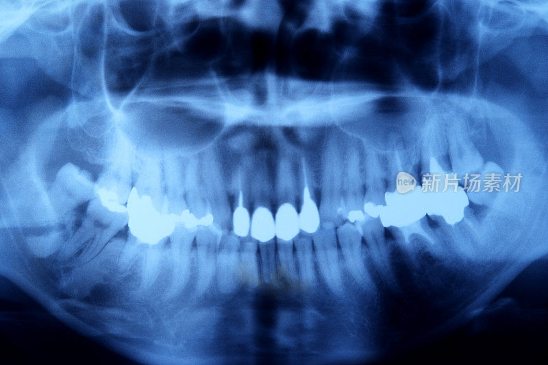 牙科x光片的蓝色图像