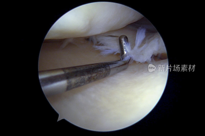 左膝内侧半月板后部复杂退行性撕裂的关节镜观察